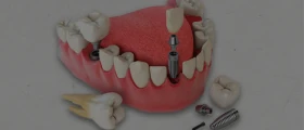 PSI 3D: Domínio, Destreza e Diferenciação em Prótese sobre Implantes