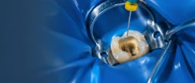 Endodontia com Habilitação em Laserterapia