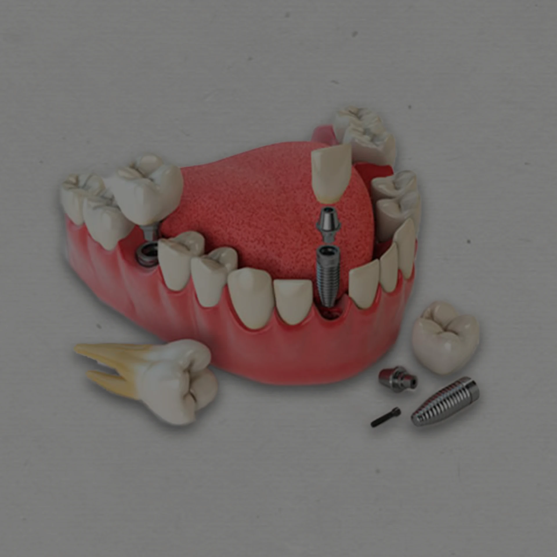 PSI 3D: Domínio, Destreza e Diferenciação em Prótese sobre Implantes